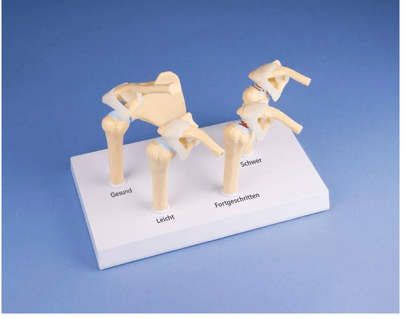 4 - Stadien - Osteoarthritis (OA) Schulter - Erler - Zimmer